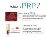 PRP Injection MD - 3